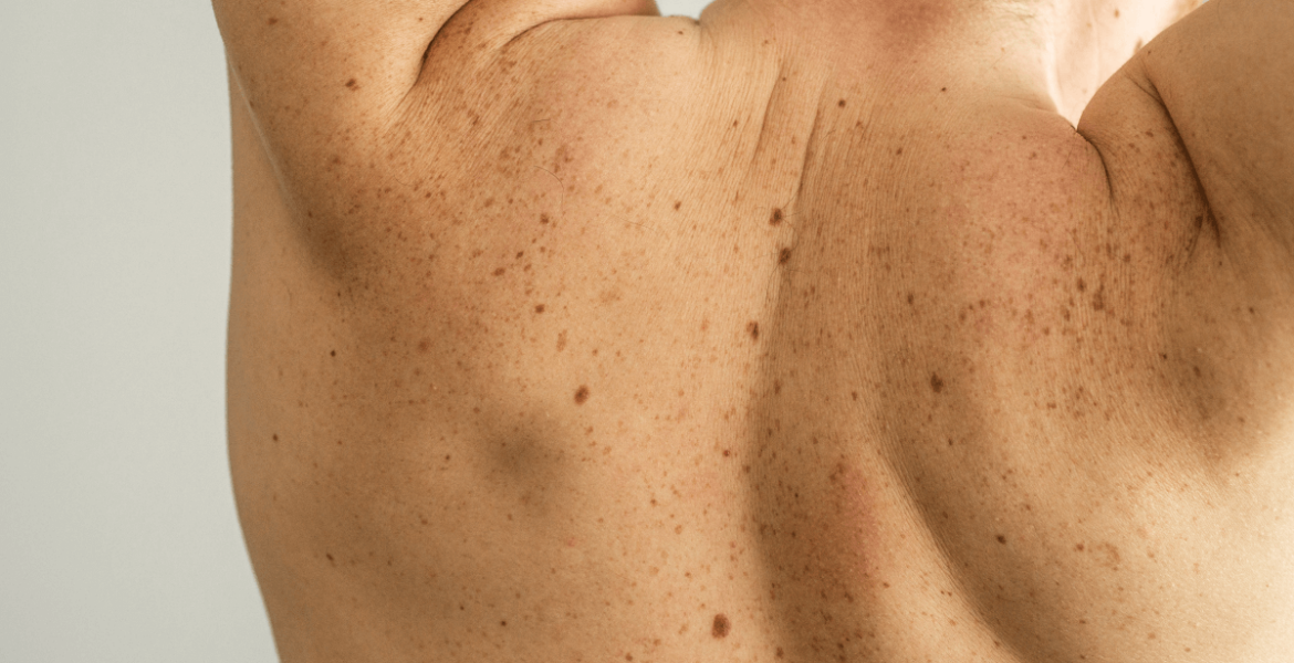 día mundial del melanoma 2023